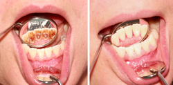 Was tun gegen Zahnbelag und Zahnfleischbluten?