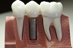 Implantologie in der Zahnheilkunde – ein kleiner Eingriff mit großer Wirkung